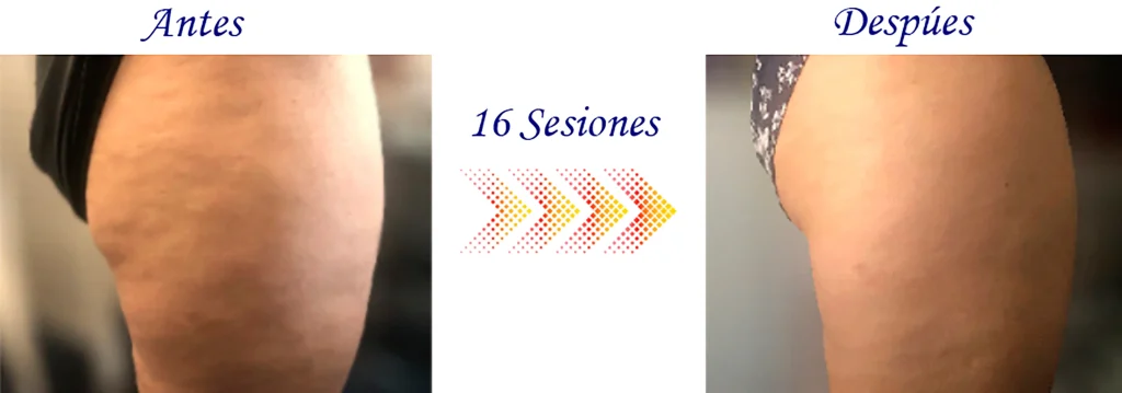 Comparación del aspecto de la piel en una pierna antes y después de 16 sesiones con el dispositivo MRM, mostrando una notable reducción de la celulitis.