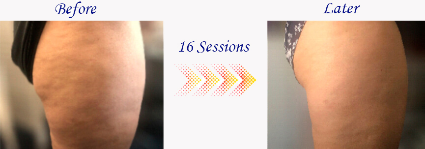 Comparison of the skin appearance on one leg before and after 16 sessions with the MRM device, showing a remarkable reduction in cellulite.